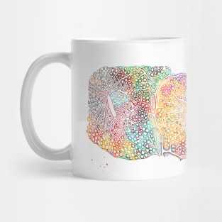 Fatty infiltration of the liver Mug